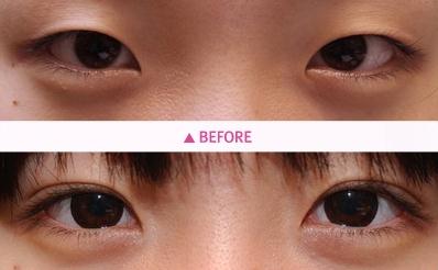 eyelid liposuction only fat double